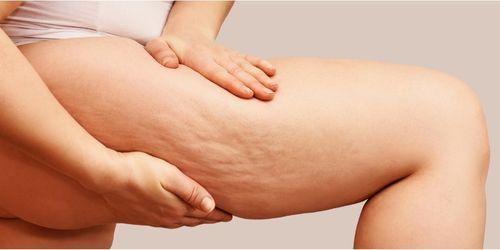 How to Reduce Cellulite